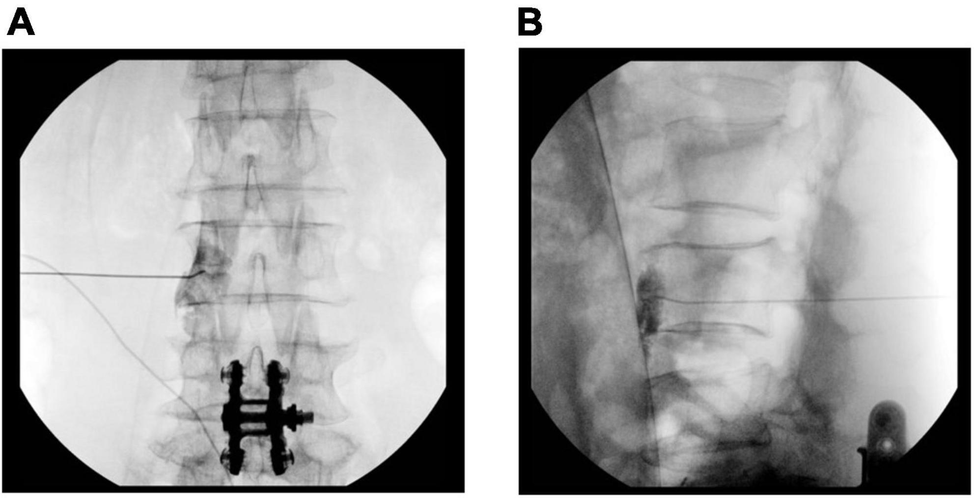 The analgesic effect of lumbar sympathetic ganglion block in patients with failed back surgery syndrome